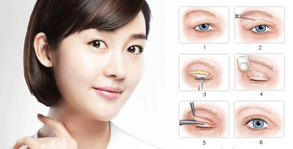 Quy trình cắt mí hàn quốc