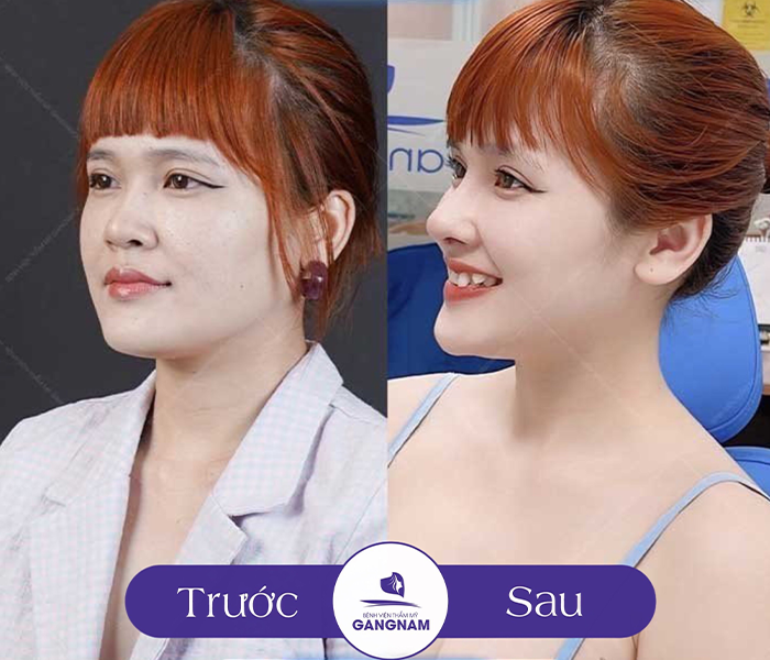 Hình ảnh Khách Hàng Trước Và Sau Khi Nâng Mũi