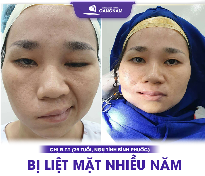hình ảnh Chị Đ.T.T (29 tuổi, ngụ tỉnh Bình Phước) bị liệt mặt nhiều năm.