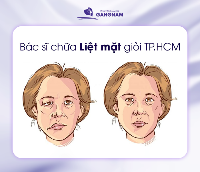 hình ảnh Liệt dây thần kinh số 7 là gì?