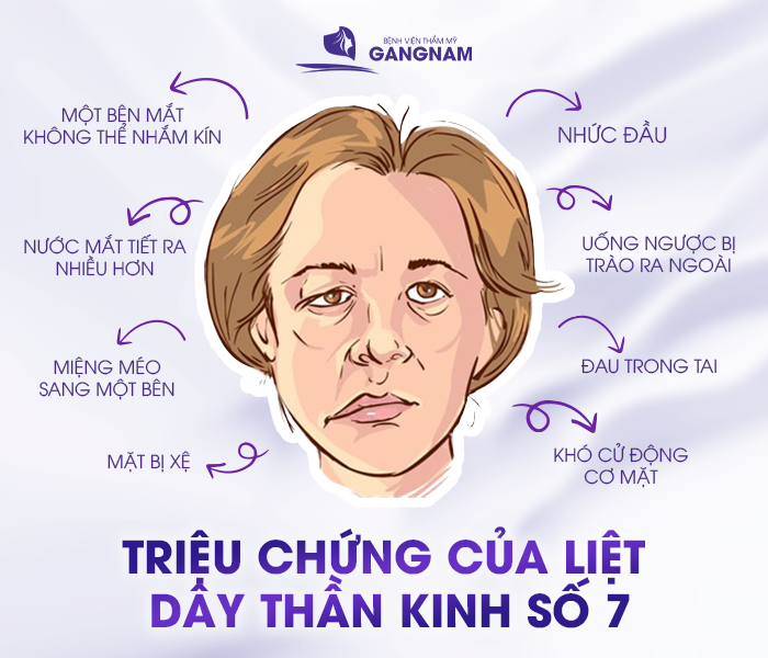 hình ảnh Các triệu chứng của liệt dây thần kinh số 7