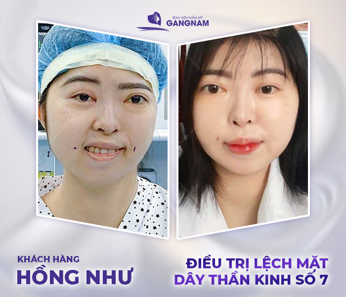 hình ảnh khách hàng điều trị liệt mặt ngoại biên