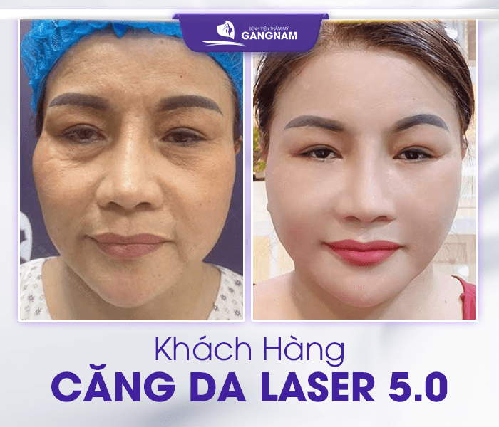 hình ảnh khách hàng căng da Laser 5.0