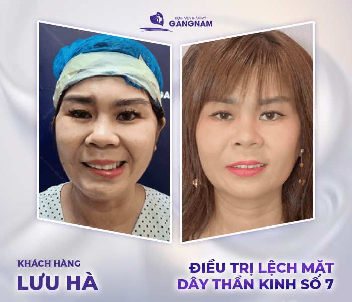 hình ảnh khách hàng điều trị liệt mặt ngoại biên