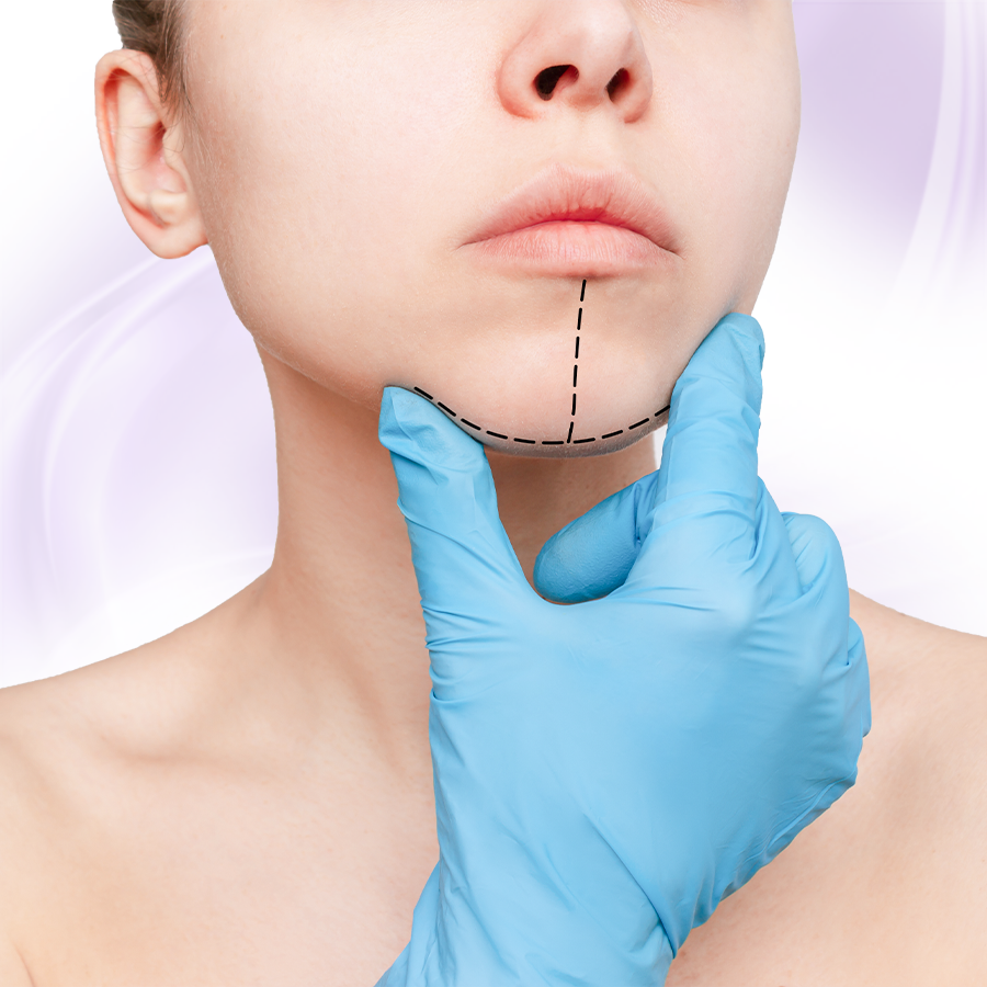 Độn Cằm (Korea Implant)