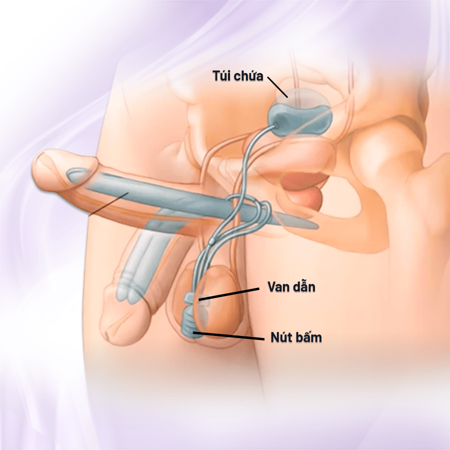 Mô tả thể hang nhân tạo