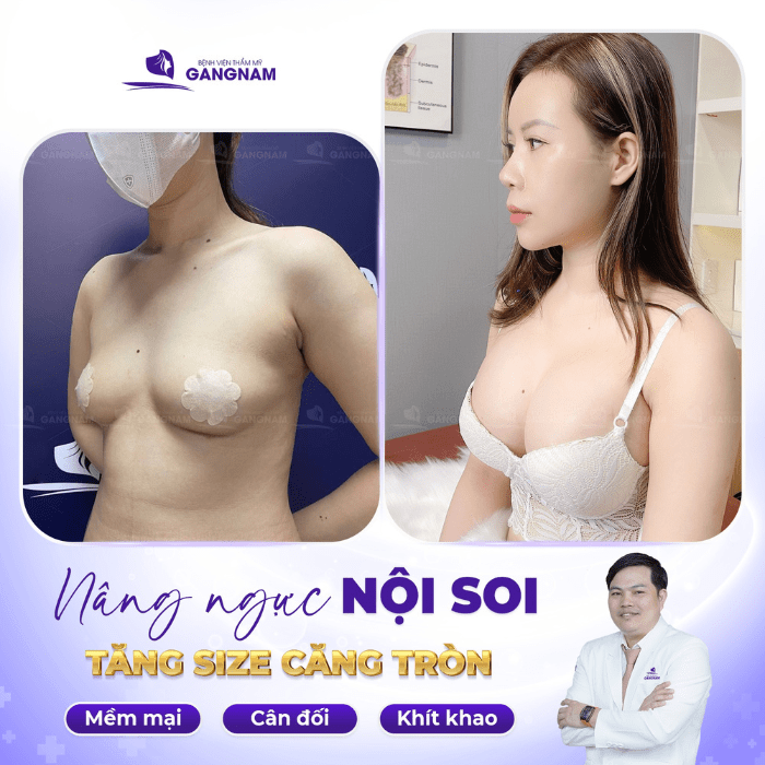 Lợi ích của nâng ngực túi độn