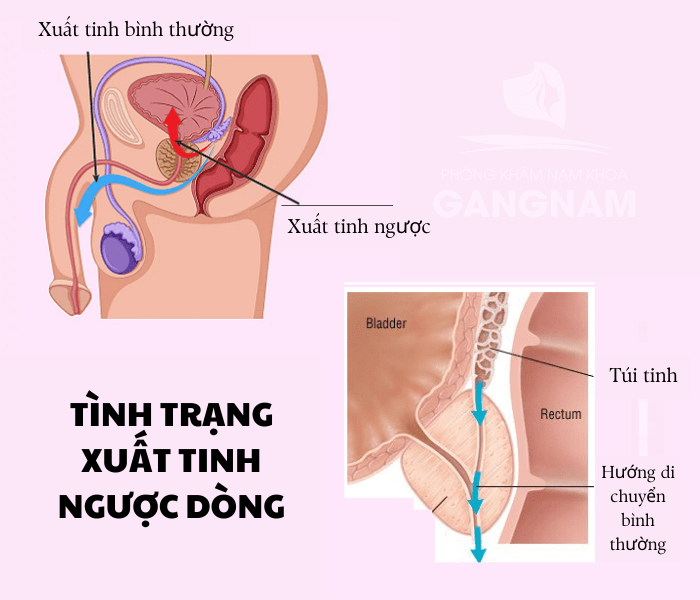 Tình trạng xuất tinh ngược dòng