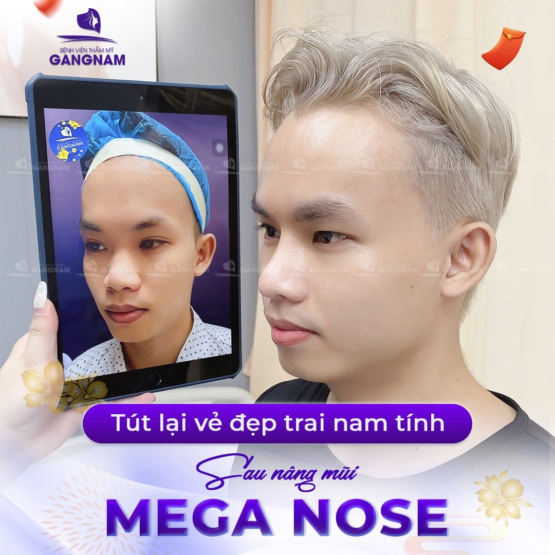 Dịch vụ nâng mũi Mega Nose sử dụng sụn Nanoform mang đến kết quả vượt mong đợi cho khách hàng