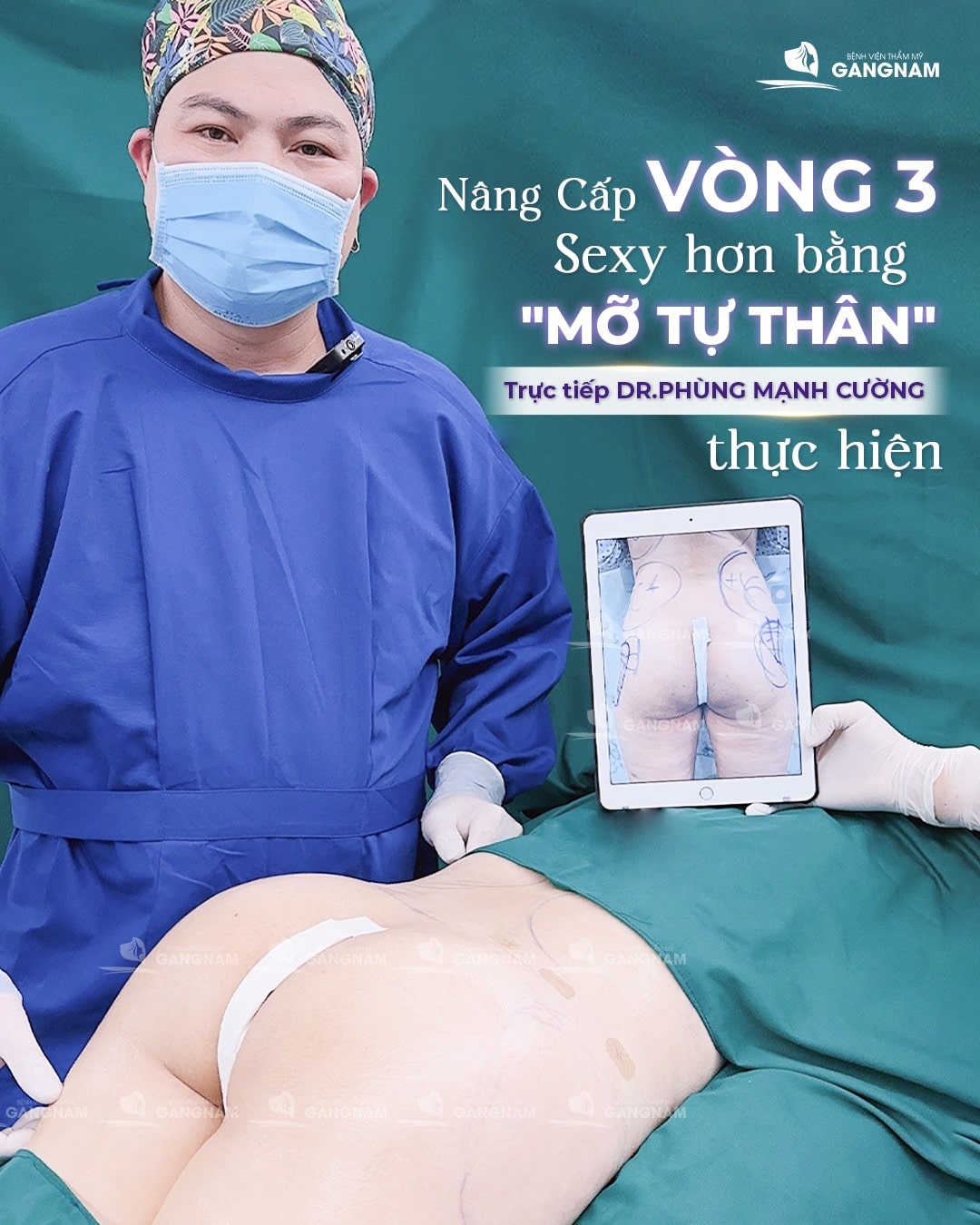 Bs Phùng Mạnh Cường trực tiếp nâng cấp vòng 3 bằng mỡ tự thân cho khách hàng