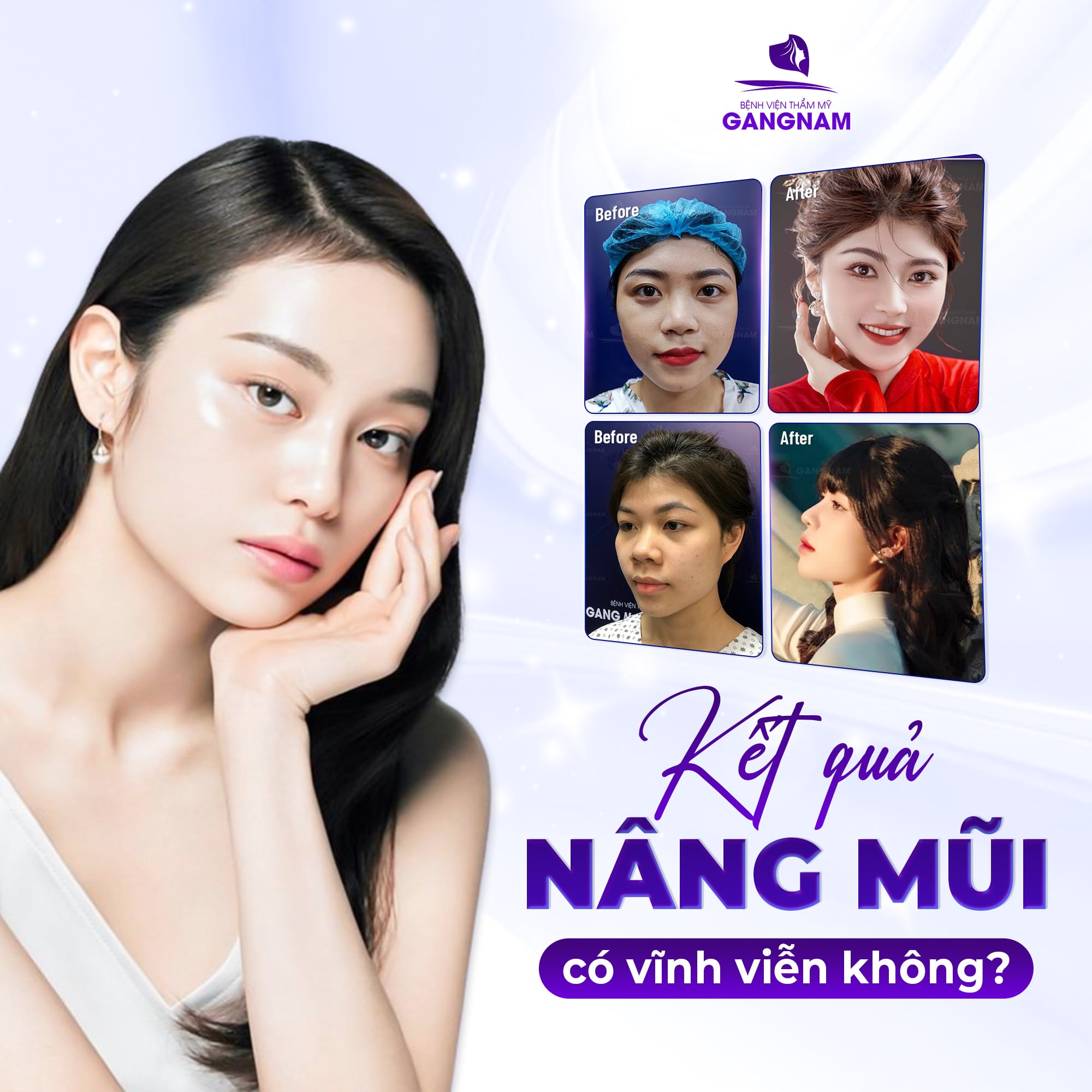 Kết quả nâng mũi có vĩnh viễn không?