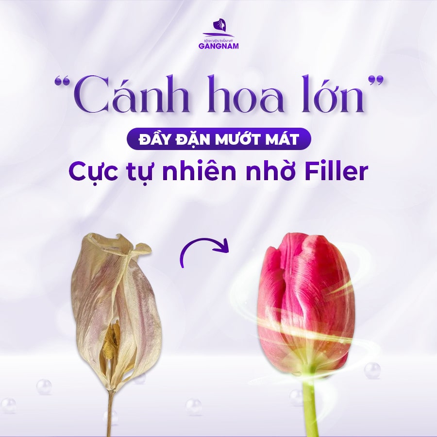 Phẫu thuật môi lớn an toàn: Hành trình lấy lại tự tin cho phái đẹp 5 Lợi ích của phẫu thuật môi lớn an toàn