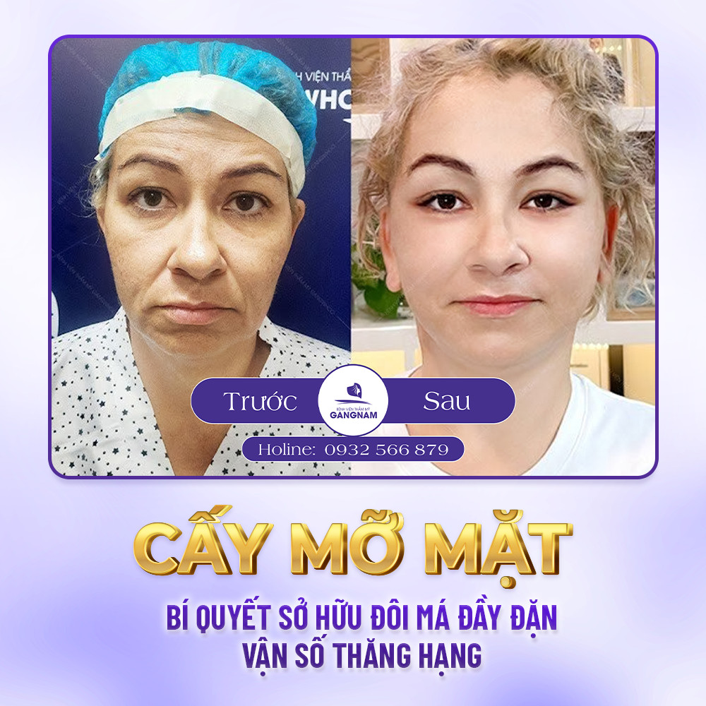 Cấy mỡ làm đầy má – Bí quyết sở hữu gương mặt tự nhiên, trẻ trung 5 Ai phù hợp để thực hiện cấy mỡ làm đầy má?