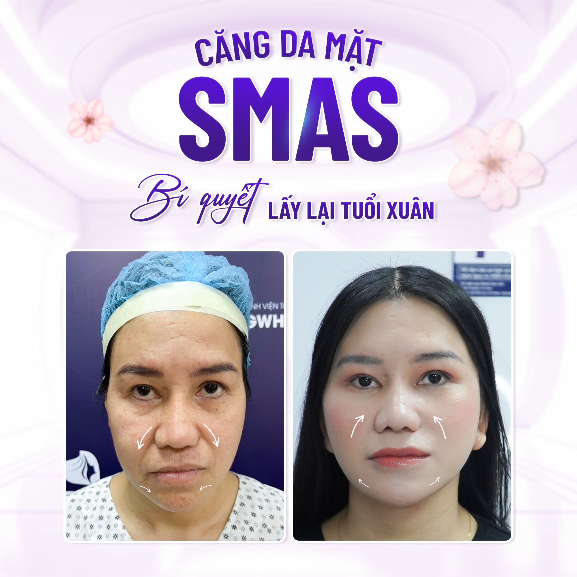căng da mặt bằng phương pháp nào tốt nhất