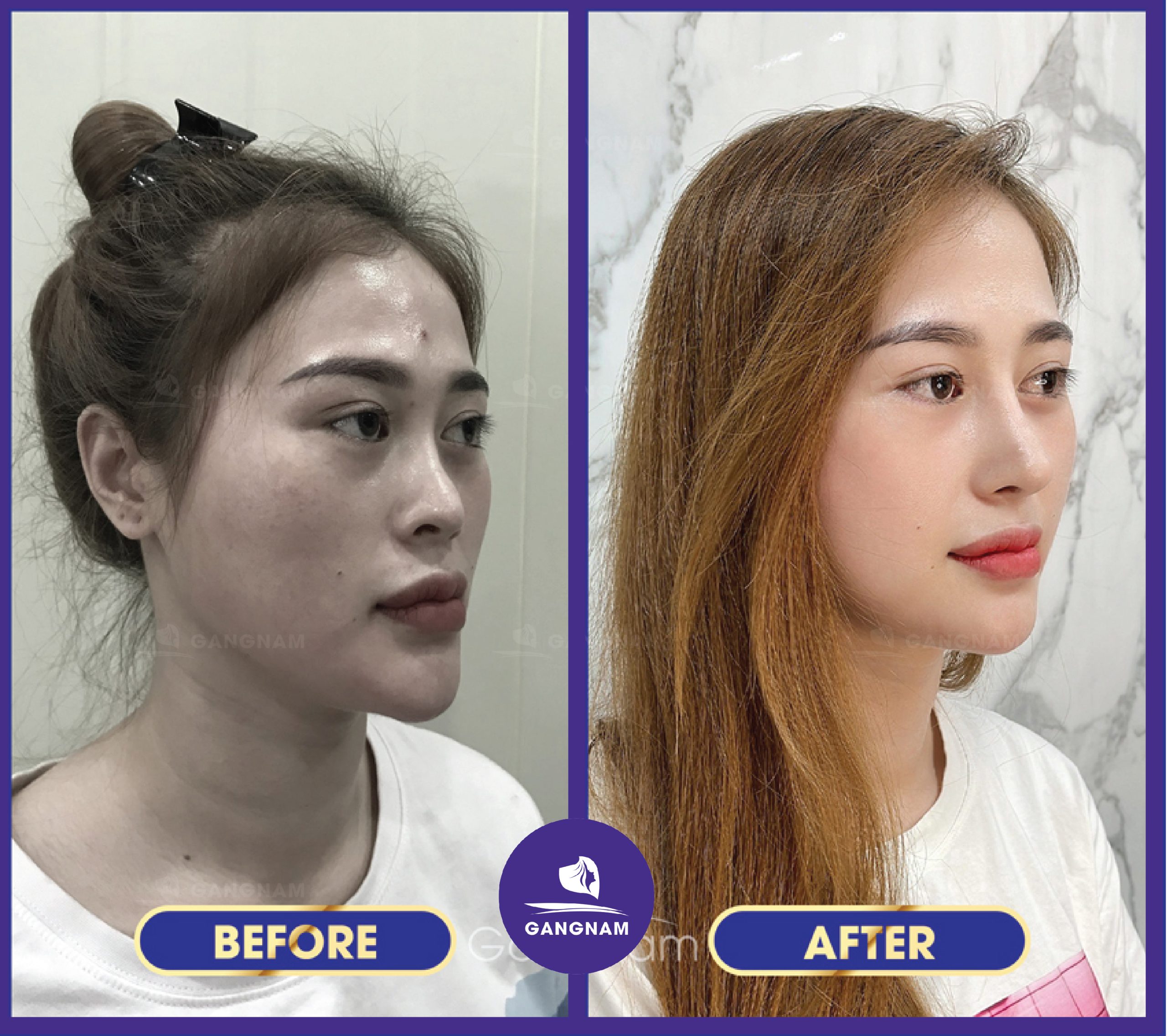 Nâng mũi không để lộ sẹo: Bí quyết để có dáng mũi đẹp tự nhiên 5 Nâng mũi không để lộ sẹo: Bí quyết để có dáng mũi đẹp tự nhiên 2