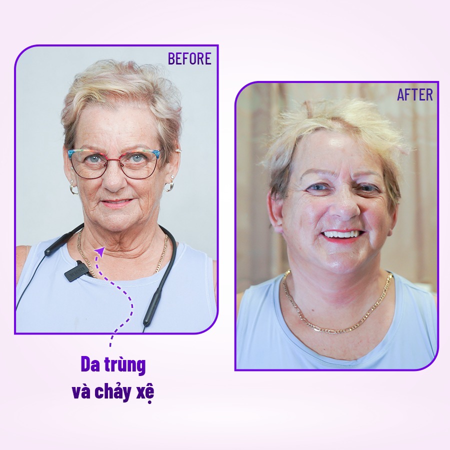 Căng da mặt bằng chỉ sinh học collagen: Bí quyết trẻ hóa không phẫu thuật 5 Ai nên thực hiện và cách chăm sóc da sau khi căng chỉ collagen