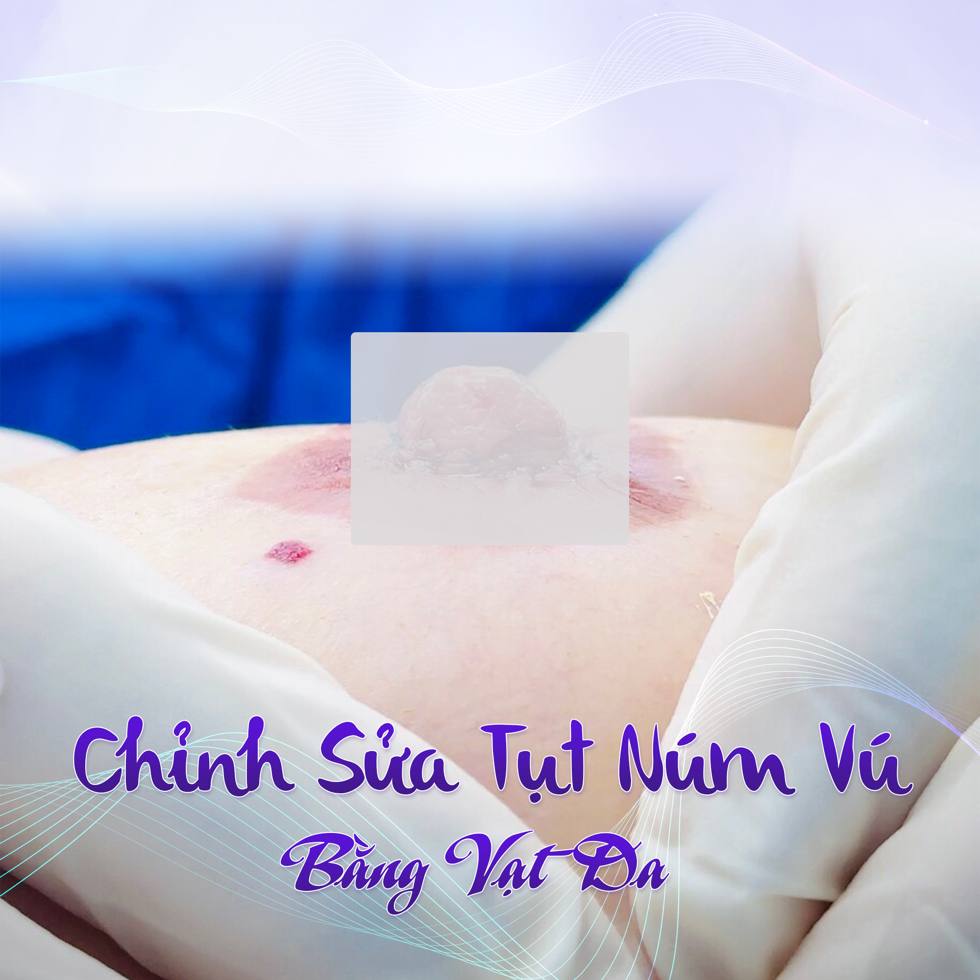 chỉnh sửa tụt núm vú