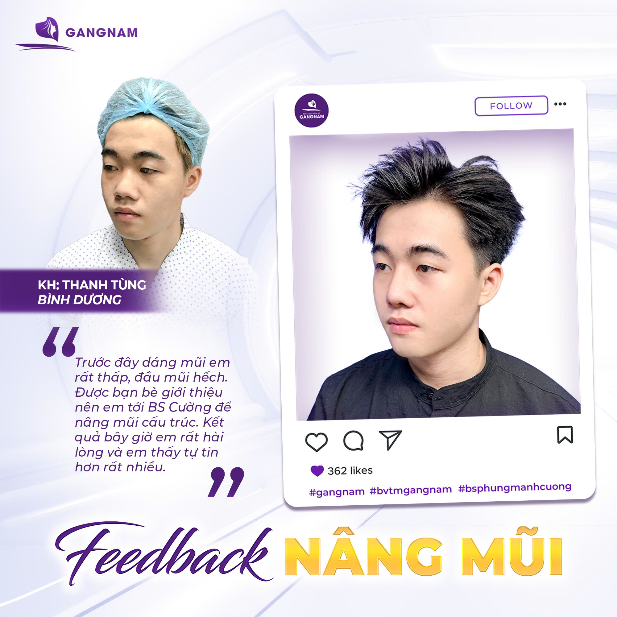 Feedback Nâng Mũi Cấu Trúc Cho Nam – Kết Quả Sau 1 Tháng Tại Gangnam 3