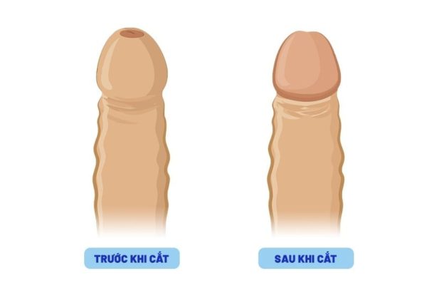 Cắt bao quy đầu không khâu: Công nghệ mới trong y khoa cho nam giới 3