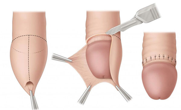 Bí quyết giúp cắt bao quy đầu phục hồi nhanh, ít đau, không biến chứng 1