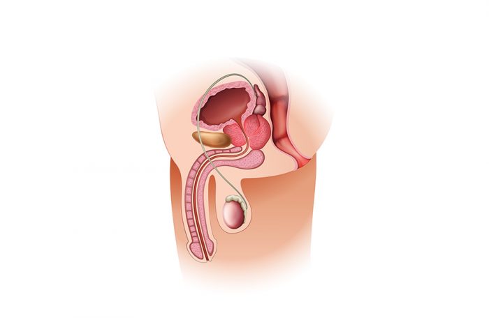 Nguyên nhân gây liệt dương và cách điều trị bằng thể hang nhân tạo 2