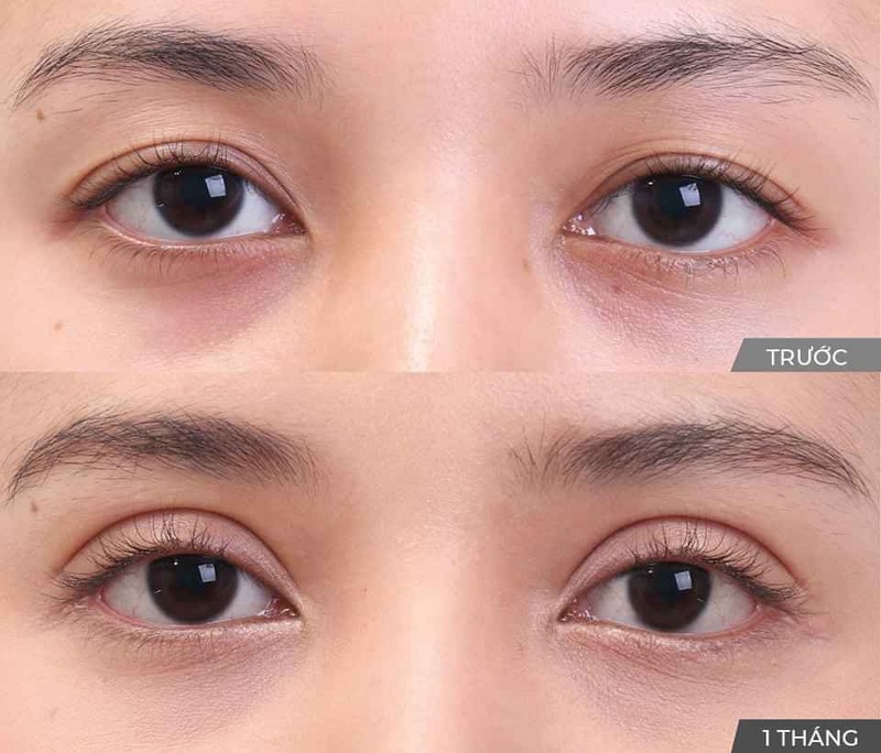 Nhấn mí Plasma là gì? Giải pháp tạo mắt hai mí không phẫu thuật 3