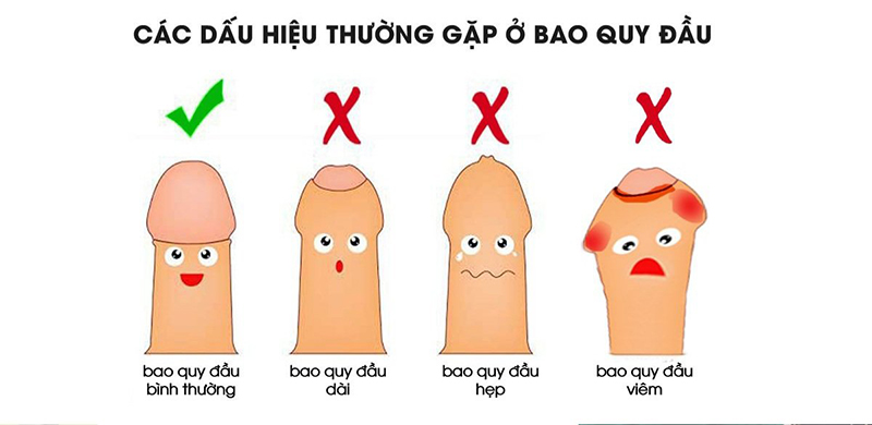 điều trị hẹp bao quy đầu