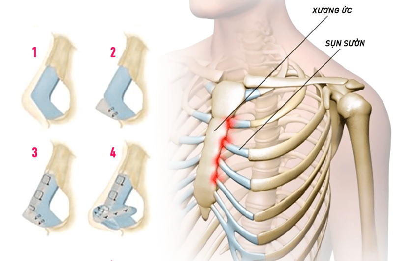 Nâng mũi sụn sườn là gì?