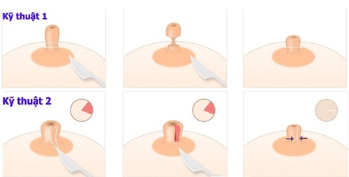 Các phương pháp thu nhỏ nhũ hoa phổ biến