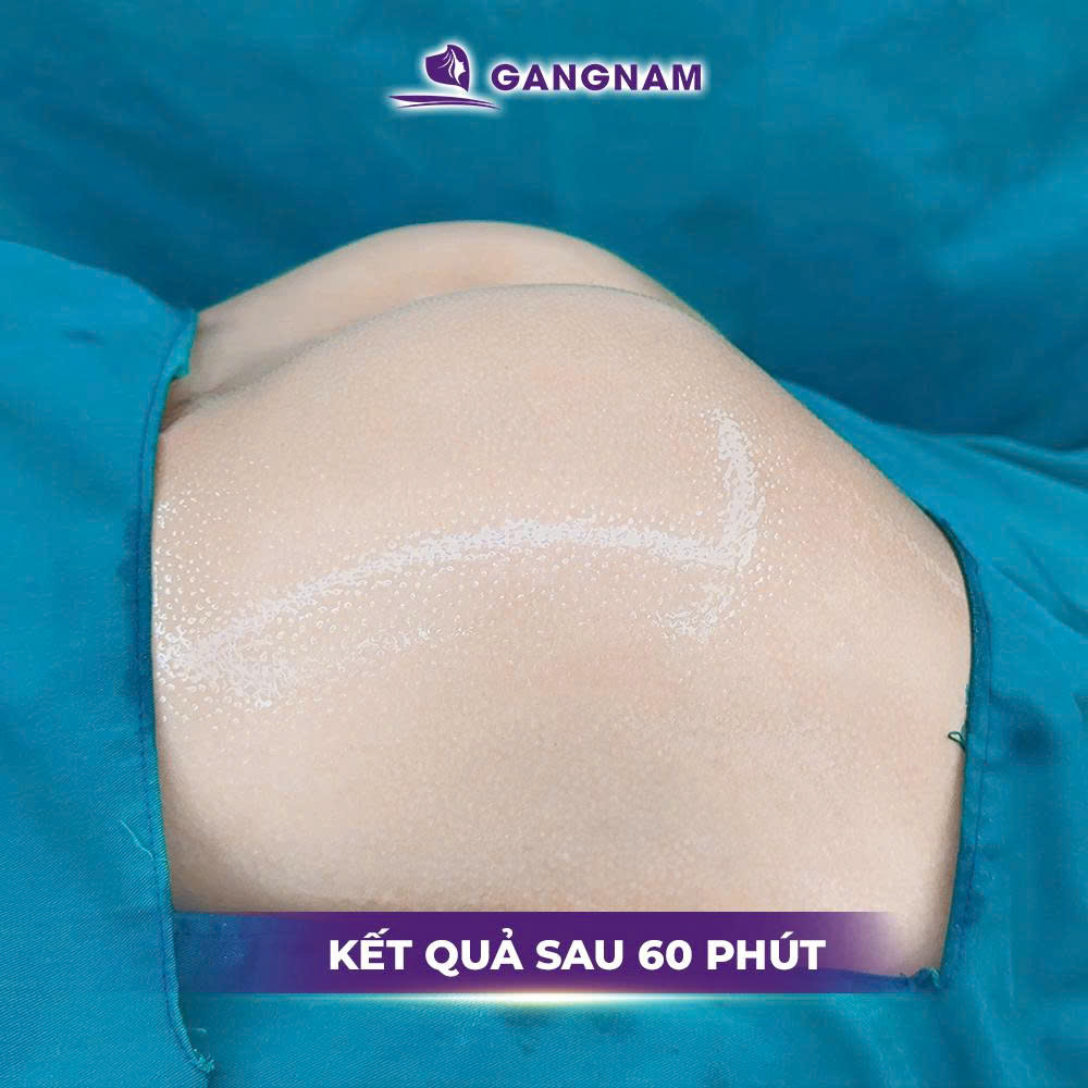 Nâng mông không đau: Giải pháp an toàn cho vòng 3 đẹp 2