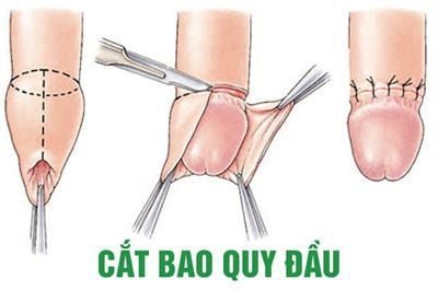 Tổng quan về cắt bao quy đầu không để lại sẹo