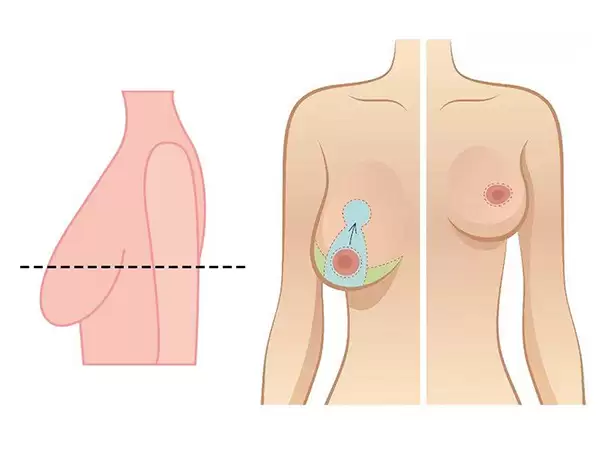 Phẫu thuật treo sa trễ
