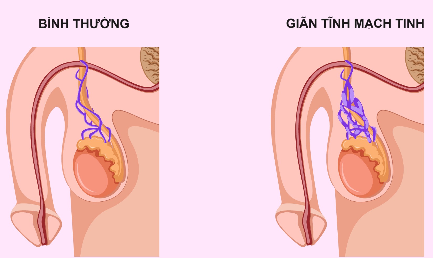 Rách tĩnh mạch dương vật là gì?