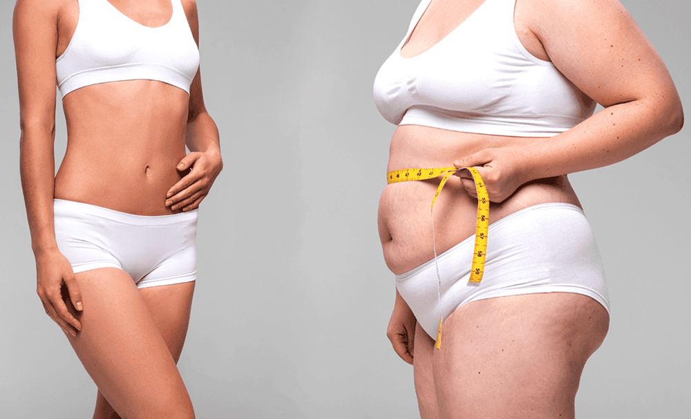 Hút mỡ Lipo Minfat có phù hợp với bạn?