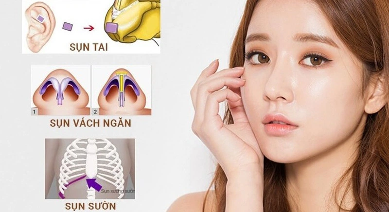 Nâng mũi sụn tự thân là gì?