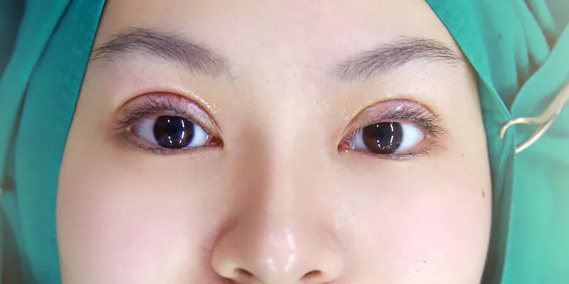 Bấm mí tự nhiên Perfect - Bí quyết sở hữu đôi mắt đẹp hoàn hảo 4 Bấm mí tự nhiên Perfect là gì?