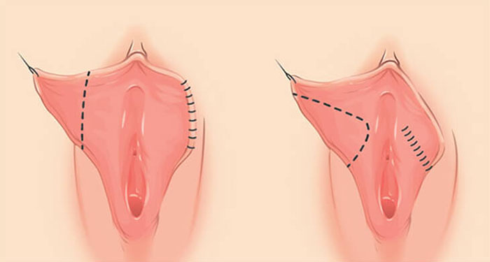 Thu hẹp cô bé bằng chỉ G-Silk