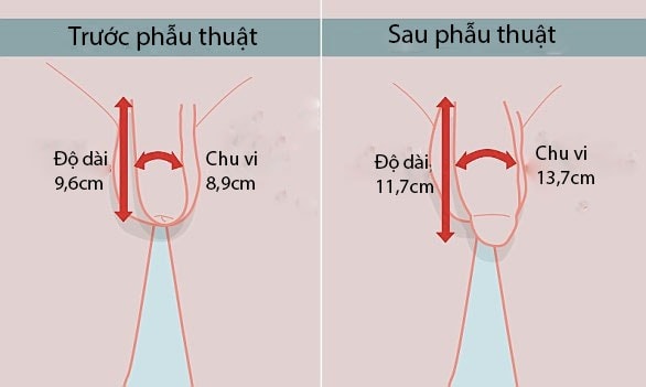 làm to dương vật