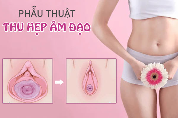 Thu hẹp cô bé là gì?