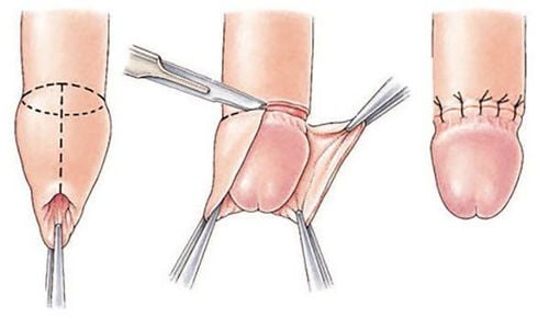 Cắt bao quy đầu không đau không chảy máu: Giải pháp hiện đại và an toàn 3