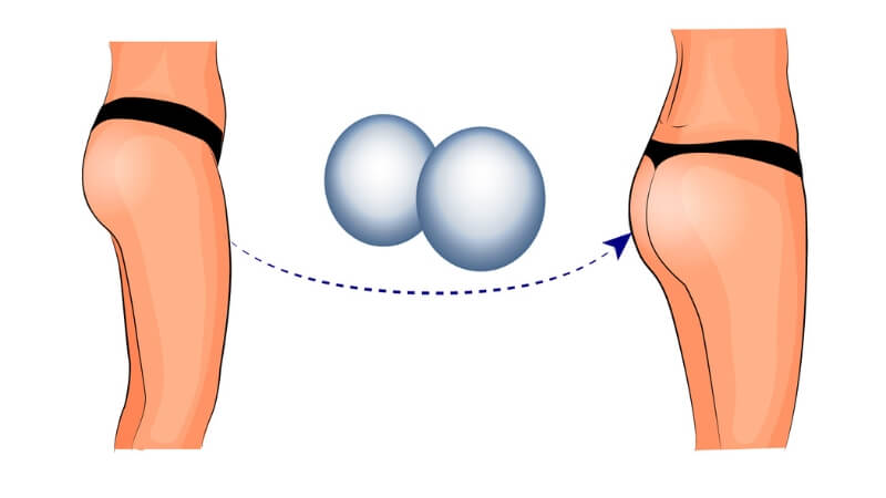 Nâng mông bằng túi độn