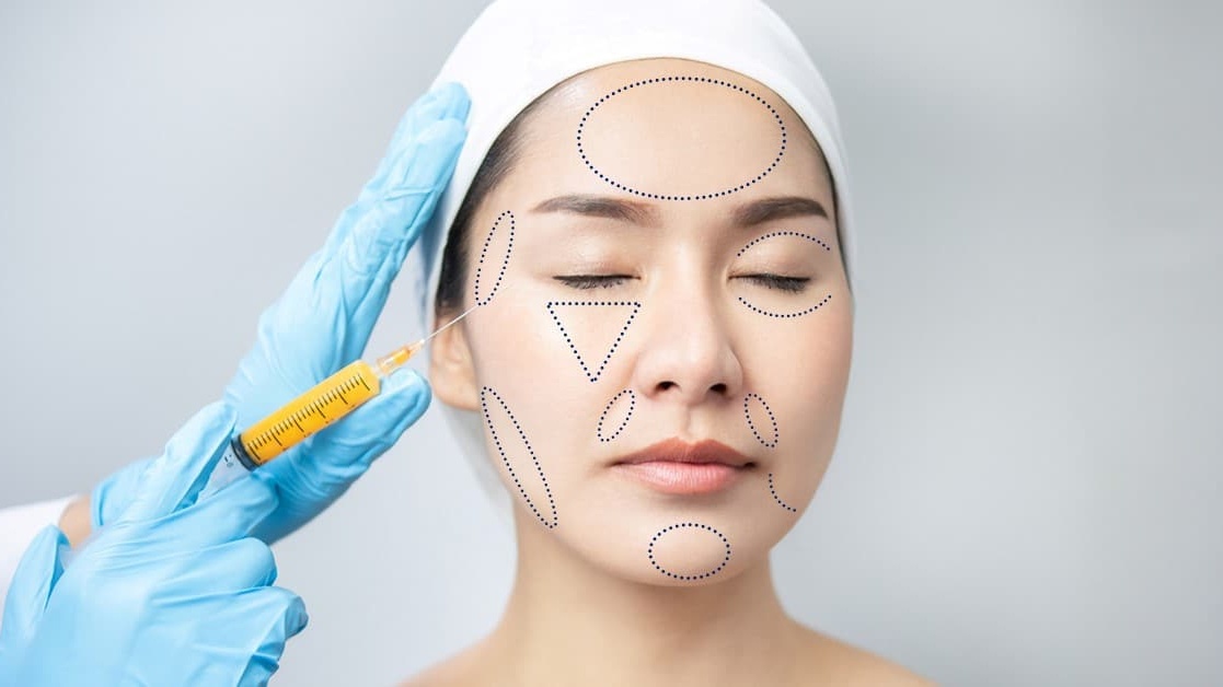 Cấy mỡ mặt tự thân là gì?