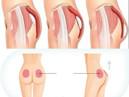 Đặt túi mông - Giải pháp nâng tầm vòng 3 hoàn hảo 4 Đặt túi mông là gì?