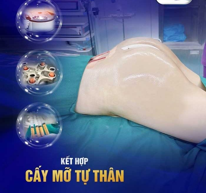 Tạo hình mông - Bí quyết sở hữu vòng 3 căng tròn, quyến rũ 5 Nâng mông bằng mỡ tự thân (BBL)