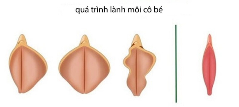 Cắt môi lớn có đau không? Giải đáp chi tiết cho bạn 4 Cắt môi lớn có đau không trong quá trình thực hiện?