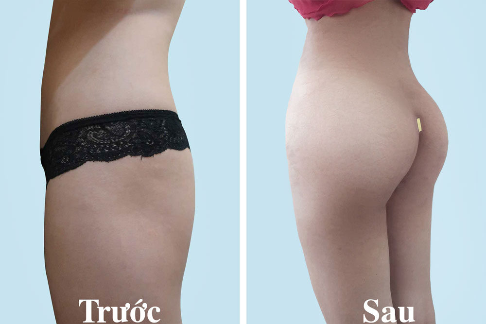 Nâng mông 3D - Bí quyết sở hữu vòng 3 hoàn hảo 5 Ai phù hợp với nâng mông 3D?