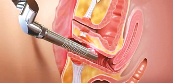 Trẻ hóa vùng kín PRP - Giải pháp thẩm mỹ hiện đại cho phụ nữ 4 Trẻ hóa vùng kín PRP là gì?