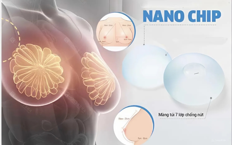 Túi ngực Ergonomic - Giải pháp nâng ngực tự nhiên và an toàn 5 Công nghệ Nanochip trong túi ngực Ergonomic