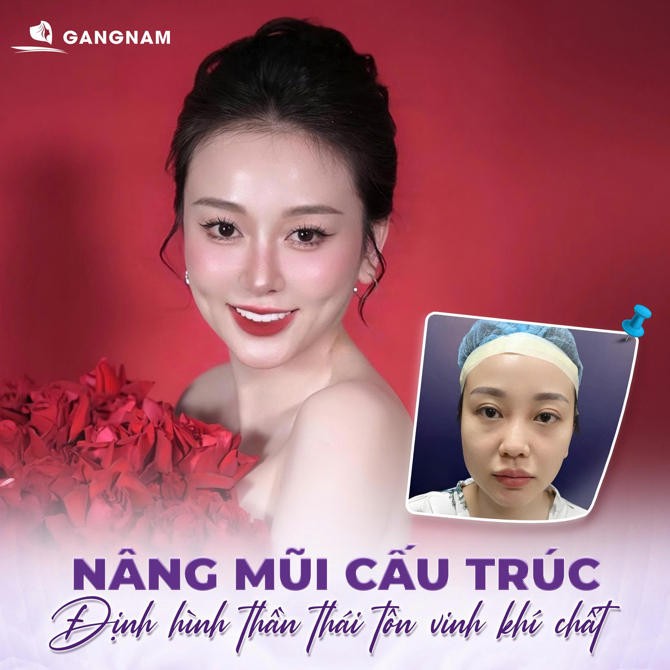 Nâng mũi cấu trúc L-line - Bí quyết sở hữu dáng mũi sắc sảo 6 Nâng mũi cấu trúc L-line – Sắc sảo và cá tính chuẩn phong cách hiện đại