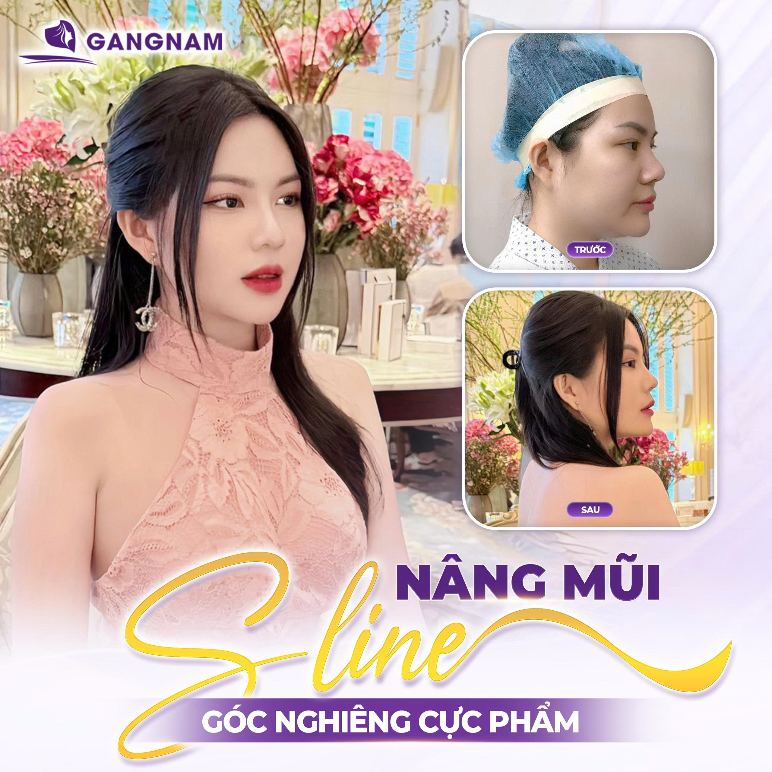 Nâng mũi bọc sụn Nano: Giải pháp cho dáng mũi đẹp tự nhiên 2